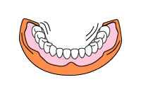 通常の入れ歯